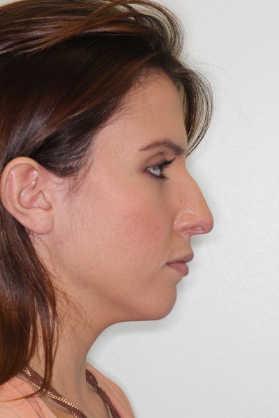 Weak Jawline? (photo) Doctor Answers, Tips