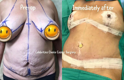 Woman treated with Mommy Makeover - Woman treated with Mommy Makeover