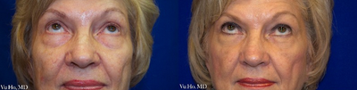 65-74 year old woman treated with Eyelid Surgery - Lower Eyelid Procedure