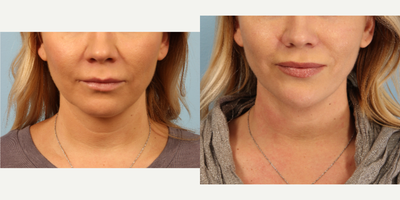35-44 year old woman treated with Skin Tightening - Chin area treated with J-Plasma powered by Renuvion for dermal tightening