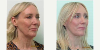 45-54 year old woman treated with Mini Facelift and Upper Eyelid Surgery under Local Anesthesia - This well-aging woman presented with the concerns of moderate jowling in her jawline, along with excessive skin over her eyelids. She stated that both of these made her appearance older than she was. She had attempted botox and fillers on more than one occasion and did not see any significant improvements. She consulted with our Center with hopes of a more definitive solution without significant downtime.After examination, we agreed that the best treatments would be a mini-jawline lift with an upper blepharoplasty. Both procedures were performed on the same day with oral sedation with xanax and local anesthesia. No IV or General anesthesia was utilized. Total procedure time for both procedures was under 2 hours. All sutures were removed 6 days after the procedure. She was able to return to work and exercise 7 days after her procedure.Her results demonstrate a more defined, and still natural, jawline along with increased show of her upper eyelids.