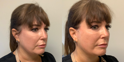 45-54 year old woman treated with Thread Lift - This patient was concerned with the appearance of her mid face and wanted a non surgical alternative. A Threadlift was performed to address her concerns.