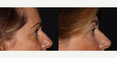 45-54 year old female treated with Eyelid Surgery - Upper Eyelid Surgery