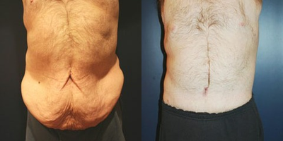 45-54 year old man treated with Male Tummy Tuck - 49 year old male one year after banding procedure by Dr. Jean Baptiste with 200 pound weight. Now complaining of excess skin of back and abdomen, abdominal strech marks, weak abdominal fascia, excess fatty tissue of abdomen requesting cosmetic surgery to rejeuvenate and make his abdomen and back look younger and less flabby.