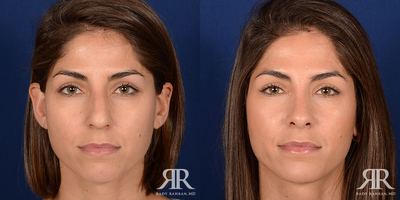 Rhinoplasty - Rhinoplasty