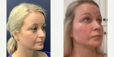 45-54 year old woman treated with Breast Fat Transfer - 45-54 year old woman treated with Facial Fat Transfer