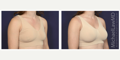 35-44 year old woman treated with Mentor Breast Implants - Breast augmentation. Follow-up photo taken 3 months after the procedure.