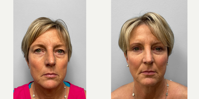 55-64 year old woman treated with Eyelid Surgery, Laser Resurfacing - This woman in her late fifties came to inquire about facial rejuvenation options with Dr. Howell who recommended an upper eyelid blepharoplasty, Juvderm, and TFX CO2 laser resurfacing in the future. She looks great and is shown before and 3 months after surgery and filler.