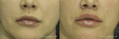 Lip Lift - Patient desired fuller lips. The lip lift procedure is done with local anesthesia, so youre awake. The upper lip lift procedure elevates the position of the upper lip with respect to the teeth giving a broader smile. The amount of pink lip that is seen is also increased giving the patient wider lips.