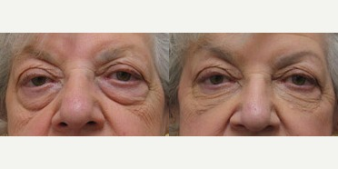 Woman treated with Restylane - Injectable Fillers