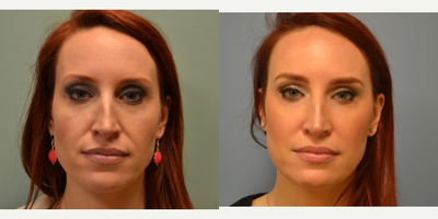 35-44 year old woman treated with Voluma - Voluma Filler to Cheeks and Juvederm to laugh lines.