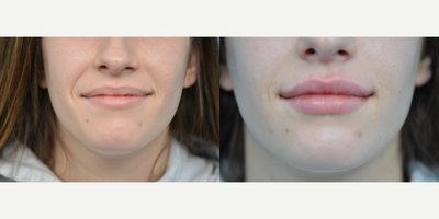 18-24 year old woman treated with Juvederm - 23 year old desiring fuller lips. Juvederm Ultra Plus was injected.