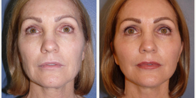 Woman treated with Laser Resurfacing - Woman treated with Facelift andNeck Lift with extended SMAS as well assmall amount ofFacial Fat Transfer, and CO2 Laser Resurfacing. Post-op, she had improved appearance in her jowls, cheeks, jawline, as well as her skin texture.