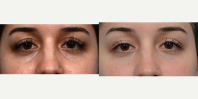 18-24 year old woman treated with Dermal Fillers - Tear trough fillers with Dr. Wise