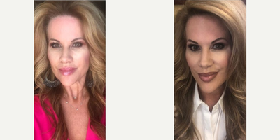 35-44 year old woman treated with Injectable Fillers - Dr. Barbarino treated her tear troughs (under eye), temples, nasolabial folds, and her jaw line/cheek area to give a beautiful lift. And then also some Xeomin for the forehead, around the eyes, and the brow. This is a great example of anti-aging and preventative treatment.