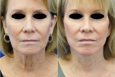 65-74 year old woman treated with Facelift Revision - 65-74 year old woman treated with Facelift Revision