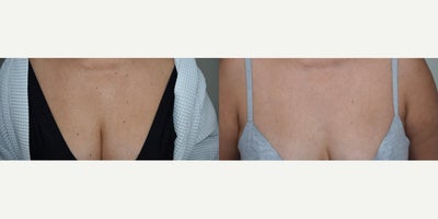 Los Angeles Mole Removal Before and After Photos - Growing older is tough! We develop all kinds of bumps and spots as we age and these small brown moles are one example. Easy for us to remove so call us today!