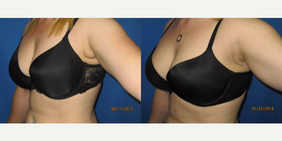 28 year old woman treated with Smart Lipo - A common area of stubborn fat is the underarm or axillary area. Many womencome to us for evaluation of these fat bulges in the front or back of the underarm area that are accentuated by the bra making them self-conscious in wearing certain kinds of dresses or shirts. This is sometimes fat, but can also be caused by accessory or abundant tail of the breast tissue.These are before and 4 month after photos of a 28 year old woman with a several year history this unwanted and uncomfortable tissue. She was treated with a simple Smartlipo laser liposuction procedure under local anesthesia.