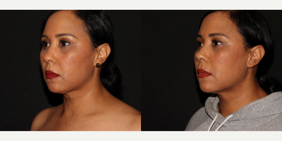 35-44 year old woman treated with Nonsurgical Facelift, Renuvion, Laser Liposuction - Liposuction to lower face and neck, renuvion to lower face and neck, MyEllevate
