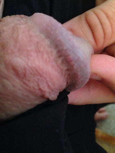 Swollen Vein On Penis 7