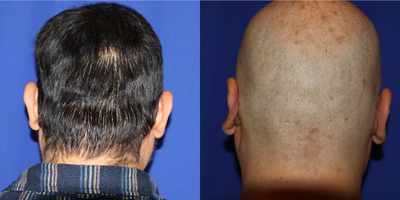 35-44 year old man treated with Ear Surgery - Wanted otoplasty