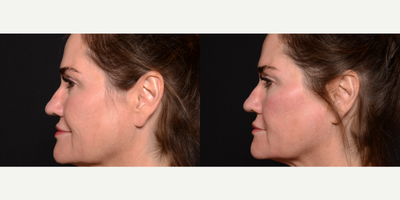 Woman treated with Microneedling - Woman treated with Microneedling