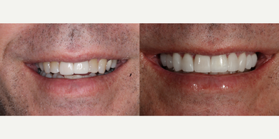 55-64 year old man treated with Porcelain Veneers, Dental Crown - 55 year old man was looking to enhance his smile. 2 front teeth had old crowns. 10 porcelain restorations were done to achieve this look.