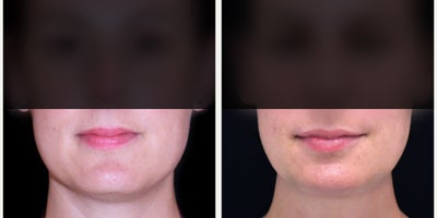 25-34 year old woman treated with Botox for TMJ - Check out these amazing results from botox for masseters.
