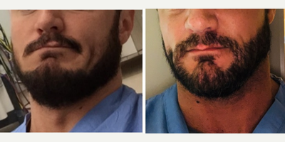 35-44 year old man treated with Hair Transplant - Before and after 1500 FUE graft to the beard to connect the mustache to the goatee and raise the cheek beard area.