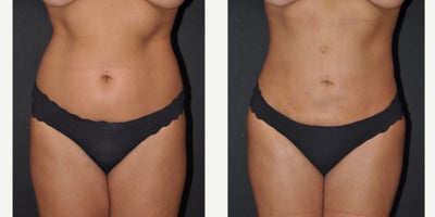 25-34 year old woman treated with Lipo 360 BBL - 360 lipo and fat grafting to buttocks