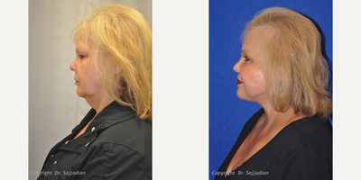 Eyelid Surgery - Eyelid Surgery