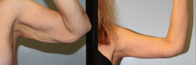 Woman treated with Arm Lift - Arm lift surgery performed by Dr. Bryson Richards.