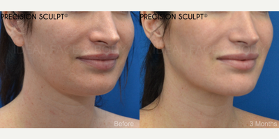 35 year old woman before and after advanced liposculpting of the chin, neck, and jawline. - This is a lovely female who wished for a more defined jawline, no double chin, and a snatched neck. We performed a specialized liposculpting procedure PRECISION SCULPT. This advanced surgery is performed under complete local anesthesia with the option of comfortable relaxation using oral medications. Tiny hidden incisions are used to evenly and smoothly remove all of the excess fat throughout the front of the neck from the chin to the angles of the jaw and down to the front of the lower neck. Laser and radiofrequency are delivered to the tissue to promote tightening. This procedure takes about 45 minutes. Patients typically return to work in a few days.