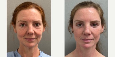 44 year old woman treated with Lower Facelift, Facelift, SMAS Facelift, Deep Plane Facelift - 44 yo s/p Deep plane face and neck lift performed under local anesthesia with sedation in our on site AAAA certified operating suite.