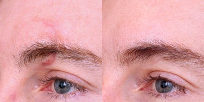 35-44 year old man treated with Scar Revision (Dermabrasion, CO2 Laser, Vascular Laser) - Scar revision with dermabrasion (surface irregularities), DeepFX (texture), and VBeam (redness). Comprehensive treatment for improved scar appearance.