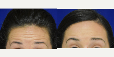 35-44 year old woman treated with Botox - Botox to relax the forehead wrinkles