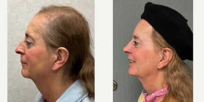 65-74 year old woman treated with Adam's Apple Reduction, Brow Bone Reduction, Brow Lift, Septoplasty, Rhinoplasty, Lip Lift, Ch - This lady underwent facial feminization surgery including forehead feminization, nasal feminization, cheek augmentation, chin feminization and adams apple reduction.