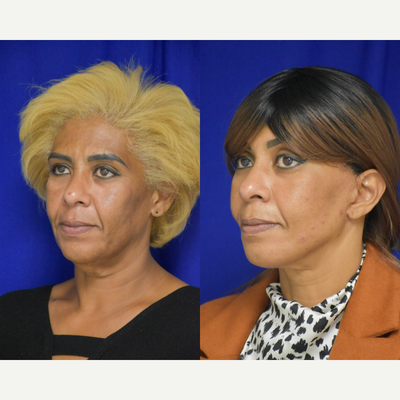 251 45-54 year old woman treated with Facelift, Facial Fat Transfer, Brow Lift - 45-54 year old woman treated with Facelift, Neck Lift, Facial Fat Transfer, Eyelid Surgery