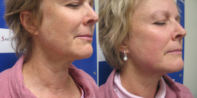 45-54 year old woman treated with Sylfirm X - Patient with hyperpigmentation and melasma, before and after 3 Sylfirm X microneedling treatments. After photo 1 month post procedure. Neck laxity