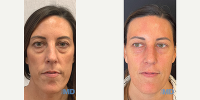 35-44 year old woman treated with AccuTite, Morpheus8 - This lovely patient took years off her appearance by addressing her undereye area with AccuTite and Morpheus8 at Skin MD.