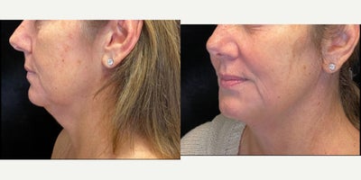 35-44 year old woman treated with Morpheus8, Microneedling RF, Facial - Series of 3 with Alyssa G.