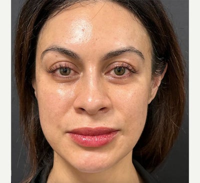 25-34 year old woman treated with Lip Lift - Lip Lift