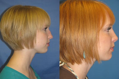 Rhinoplasty -
Endonasal Septorhinoplasty, patient had difficulty breathing and was concerned about the shape of the tip and dorsum. A closed approach with delivery of the tip was done. A collumelar strut graft was used.