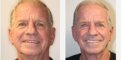 65-74 year old man treated with Dental Implants - Full upper and lower implant supported locator dentures
