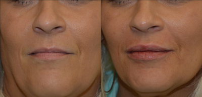 35-44 year old woman treated with Lip Augmentation - Lip enhancement immediately following injection of 1cc of Vollbella, resulting in improved fullness and shape.