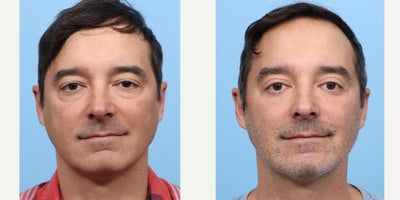 45-54 year old man treated with Eyelid Surgery, Double Eyelid Surgery - This patient chose to have upper and lower blepharoplasty with Dr. Wise to address drooping eyelids and under-eye puffiness that made them look tired. The result is a refreshed, more youthful appearance that still looks natural.