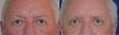 65-74 year old woman treated with Eyelid Surgery - Upper Eyelid Procedure