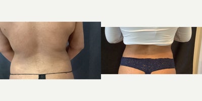 25-34 year old woman treated with Laser Liposuction - Smartlipo liposuction of abdomen and flanks