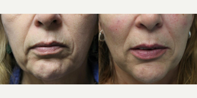 Woman treated with Botox - Woman treated with Botox
