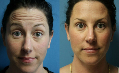 Woman treated with Botox - Woman treated with Botox